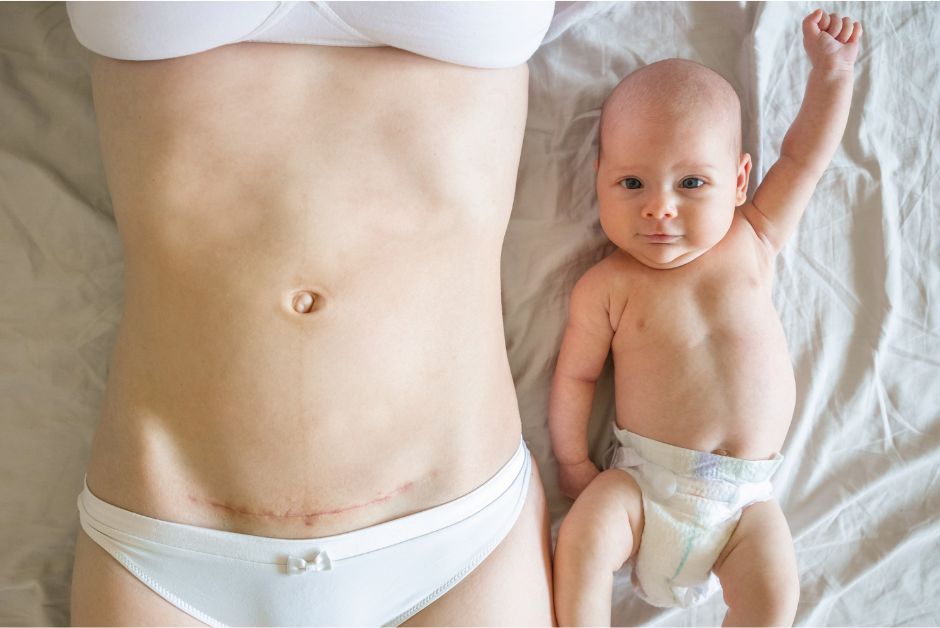 C-Section Recovery Timeline: The First 2 Weeks at Home