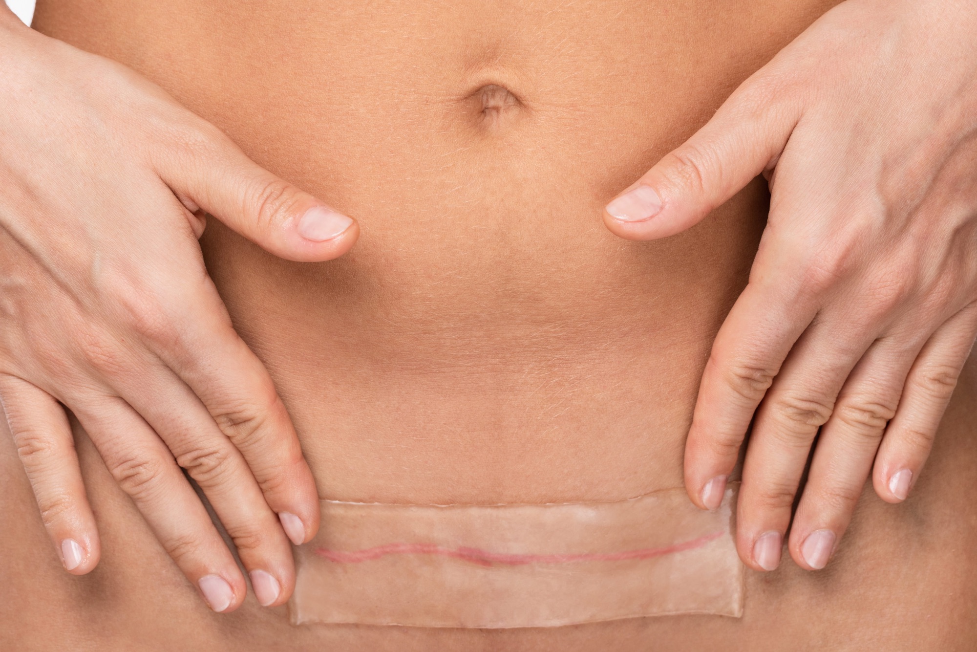 C-Section Pain Management: Tips, Tools, and Strategies for Recovery